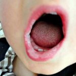 Aphthous stomatitis in children