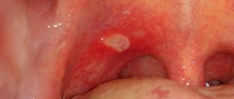 aphthous stomatitis