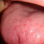 Tongue allergies can cause pain