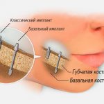 basal dental implantation