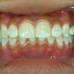 White spots on teeth