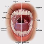 Белые точки в горле: причины и лечение