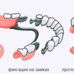 Болезнь десен под протезом