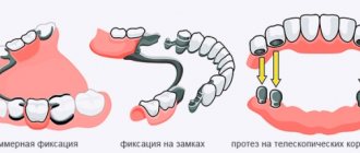 Gum disease under dentures