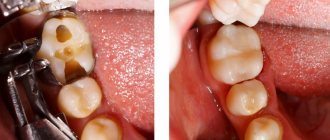 Болит зуб под пломбой 3