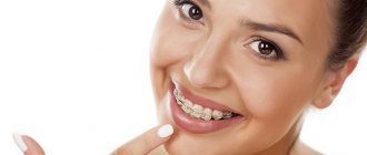 Partial braces. Ideal correction system 