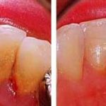 Читка зубного камня, до и после