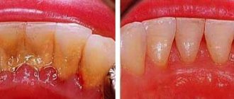 Читка зубного камня, до и после
