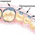 Что такое брекет-система