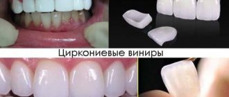 Zirconium veneers photo