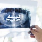 Diagnosis of catarrhal gingivitis