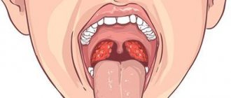 Diagnosis of tonsil cysts