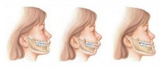 Distal bite - types