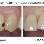 До и после композитной реставрации зубов