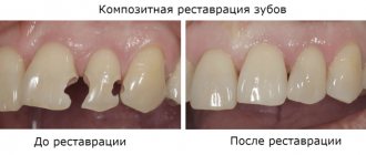 До и после композитной реставрации зубов