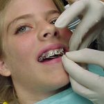 До скольки лет можно ставить брекеты на зубы взрослым