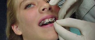 Until what age can adults get braces on their teeth?