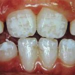 Discolored tooth enamel