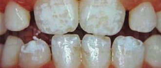 Discolored tooth enamel