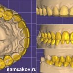 Этапы цифрового моделирования улыбки на винирах Digital Smile Design