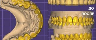 Stages of digital smile modeling using veneers Digital Smile Design