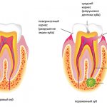 Stages of formation of a dental cyst