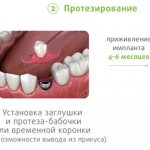 stages of implantation of one tooth ROOTT