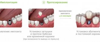 stages of implantation of one tooth ROOTT