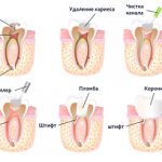 Stages of restoring a tooth on a pin