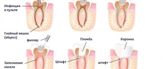 Этапы восстановления зуба на штифте