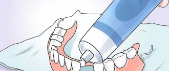 фиксация зубных протезов при полном отсутствии зубов