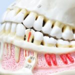 Forms of osteomyelitis of the jaw