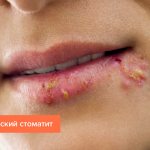 Photo of herpetic stomatitis