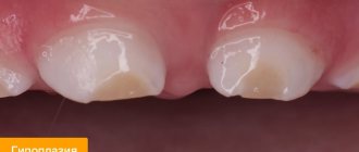 Photo of hypoplasia on a child’s teeth