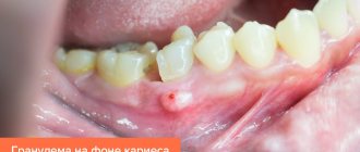 Photo of granuloma against the background of caries