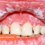 Photo of candidal stomatitis