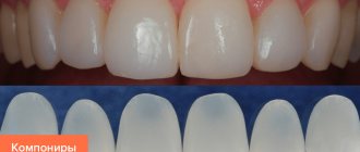 Photos of composites on teeth