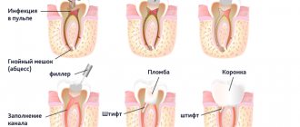 Photo of root canal treatment