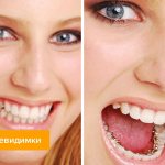 Фото пациентки с брекетами-невидимками на зубах