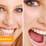 Photo of a patient with invisible braces on her teeth