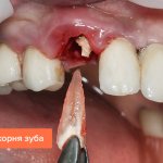 Photo of tooth root removal