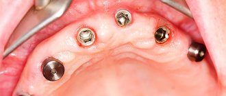 Фото зубных имплантов на верхней челюсти