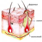 Фурункул