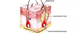 Фурункул