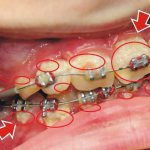 Гигиену полости рта при ношении брекетов сохранять в идеальном виде очень проблематично. Зубные отложения и развитие в зубном налете бактерий - обычное дело
