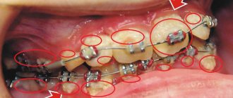 Maintaining perfect oral hygiene when wearing braces is very problematic. Dental deposits and the development of bacteria in plaque are common 