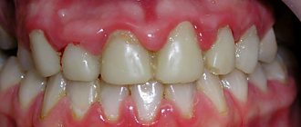 Hypertrophic gingivitis