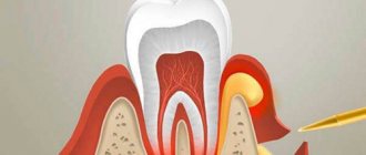 pus from the gums near the wisdom tooth