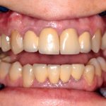 Implantation of two teeth - features and options - photos before treatment