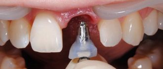 dental implantation